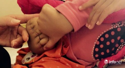 Bệnh nhi bị cắt chân lên tận bẹn vì ung thư xương - ảnh 1