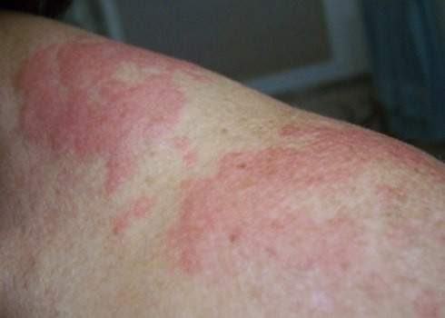 Ăn cua đồng, quý ông khốn khổ vì nổi mề đay ở “chỗ kín” - ảnh 1