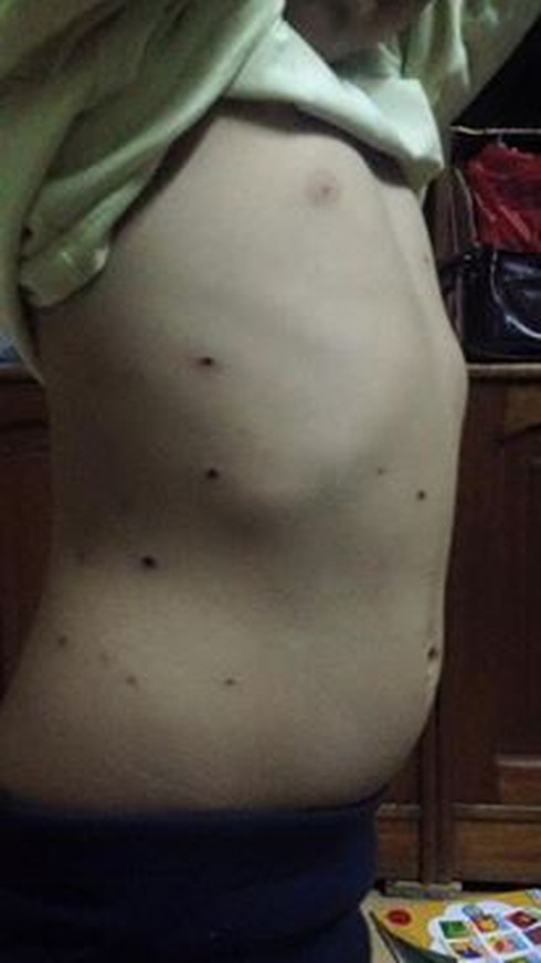 Những sai lầm chết người của bố mẹ khi chăm con bị thuỷ đậu - ảnh 1