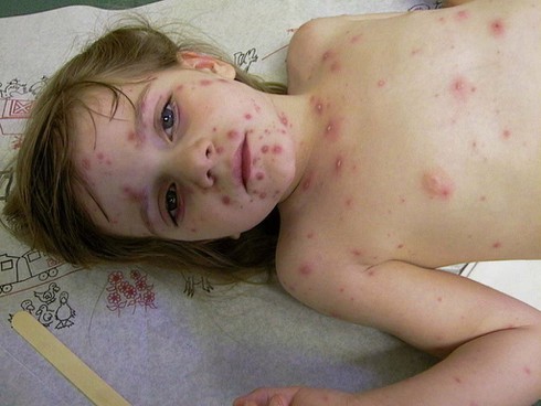 Những sai lầm chết người của bố mẹ khi chăm con bị thuỷ đậu - ảnh 2