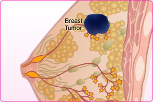 Bị ngứa đầu nhũ hoa, đi khám phát hiện bị ung thư vú - ảnh 1
