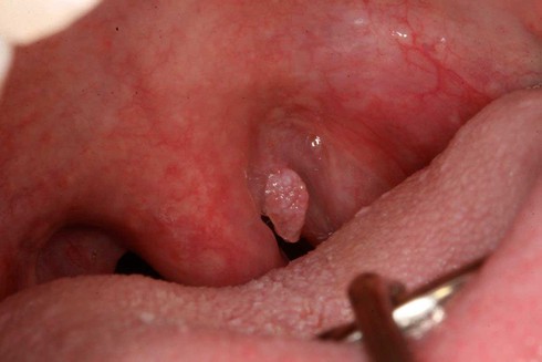 Một phút “lên tiên” của chồng, 20 năm vợ ôm bệnh sùi mào gà - ảnh 1