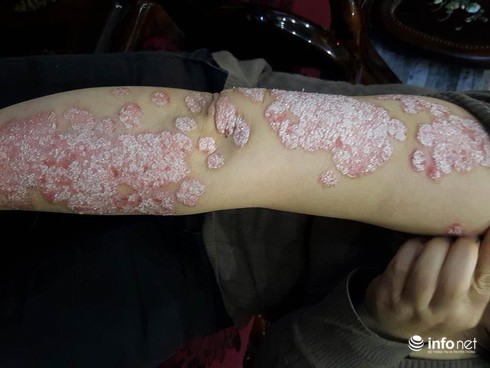 Mang bệnh này, không dám mặc áo cộc tay, xuống bể bơi - ảnh 1