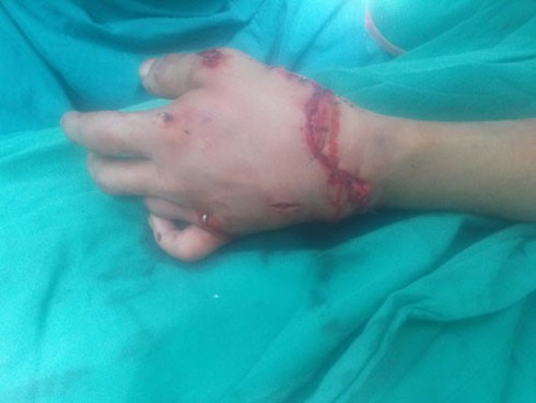 Những dặn dò của bác sĩ ai cũng phải nhớ khi gặp sự cố đứt lìa chi - ảnh 1