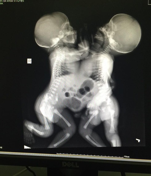 Bác sĩ ra chợ xin từ thiện cứu 2 bé song sinh dính liền: Bị trách nhưng vẫn vui - ảnh 2