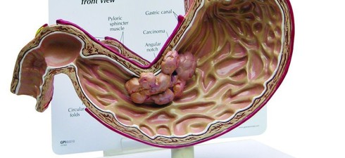 Thủ phạm nào gây ung thư dạ dày thông qua đường ăn uống? - ảnh 1