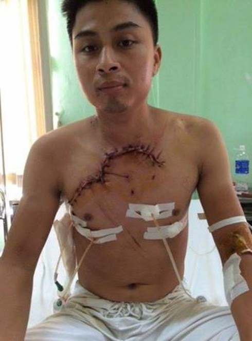 Cứu sống bệnh nhân tim và phổi lộ ra ngoài lồng ngực - ảnh 1