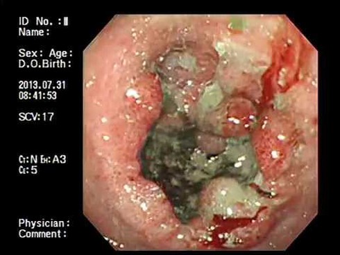 Bố mẹ sốc khi bé 5 tuổi suýt bị ung thư vì lây từ ông ngoại - ảnh 1