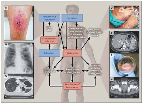 Kinh hãi loại vi khuẩn có trong đất, nước và gây tử vong nhanh chóng - ảnh 1