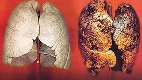 Bị ung thư phổi, phải làm gì để chiến thắng bệnh hiểm nghèo? - ảnh 1