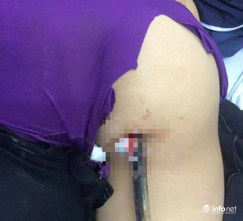 Nữ sinh 15 tuổi bị thanh sắt từ xe 3 bánh đâm xuyên người - ảnh 1