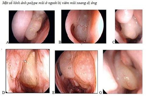 Chuyên gia tai mũi họng cảnh báo những bệnh nguy hiểm xuất hiện ...