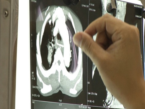 Hóc xương gà ngày tết, cụ ông nguy kịch - ảnh 1