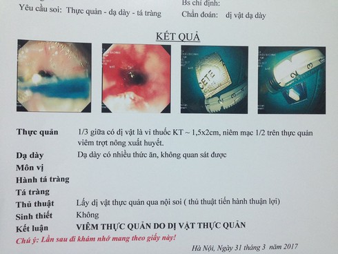 Nam thanh niên bị hóc vỏ viên thuốc - ảnh 1