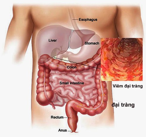 Nếu không muốn ung thư đại trực tràng, hãy ngừng ăn triền miên các món này - ảnh 1