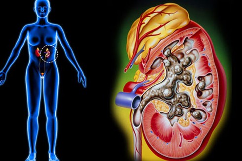 Ngộ độc vì tự chữa sỏi thận bằng kim tiền thảo - ảnh 2