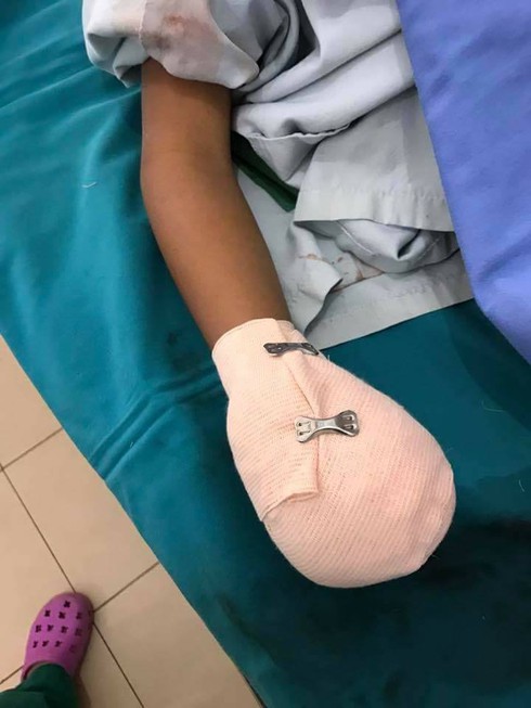 Cháu bé bị nát tay do sạc điện thoại - ảnh 1
