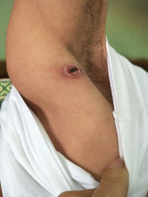 Sốt mò: Căn bệnh nguy hiểm dễ bị lãng quên - ảnh 1