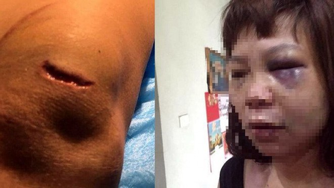 Quảng Ninh: Bắt giam kẻ đánh vợ dã man