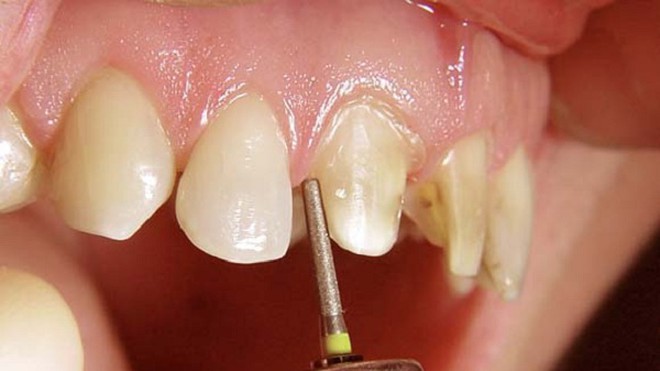 What are the potential regrets associated with getting dental porcelain crowns?