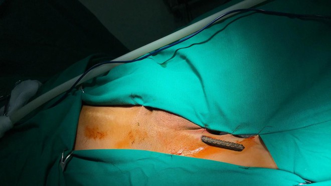 Cấp cứu cho nam bệnh nhân bị thanh sắt xiên thấu từ đùi lên bụng