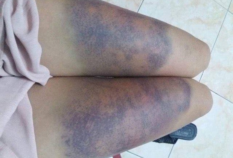 Cô gái “tố” bị bạn trai ghen tuông hành hung dã man - ảnh 2