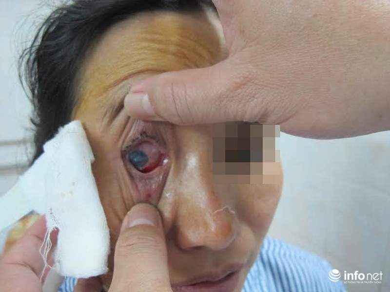 Mù mắt vì dây chun buộc đồ - ảnh 1