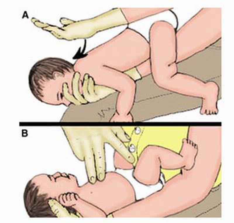 Làm gì khi trẻ bị sặc sữa? - ảnh 1