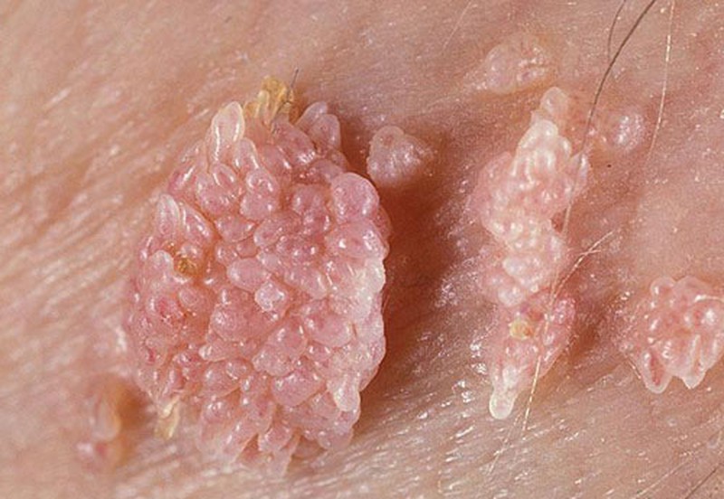 Mắc sùi mào gà sau khi quan hệ với sếp, cô gái trẻ vỡ mộng - ảnh 1