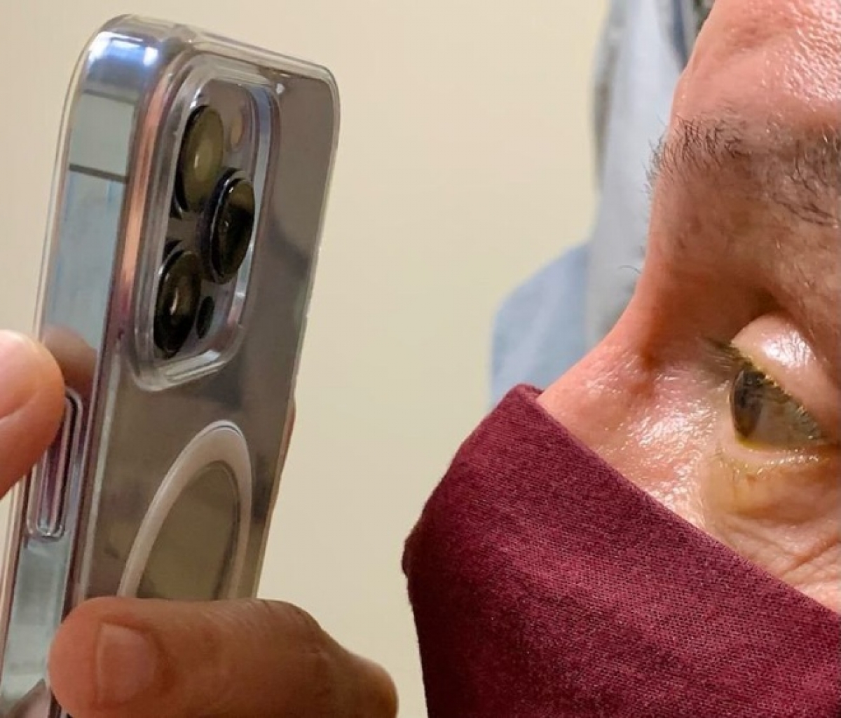 Bác sĩ Korn dùng camera trên iPhone 13 Pro Max để theo dõi tình trạng giác mạc của bệnh nhân.
