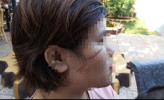 Bắt khẩn cấp nghi can chặn xe rạch mặt cô gái 26 tuổi ở Bà Rịa - Vũng Tàu - Ảnh 2.