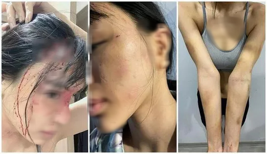 Điều tra vụ siêu mẫu Khả Trang tố chồng chưa cưới hành hung - Ảnh 1.