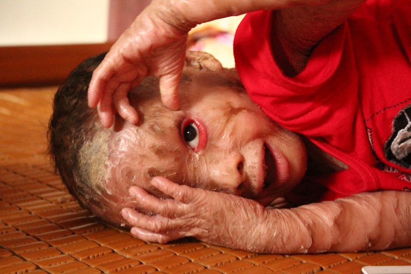 Xót thương 2 chị em mắc bệnh lạ, không dám đi học vì bạn gọi là