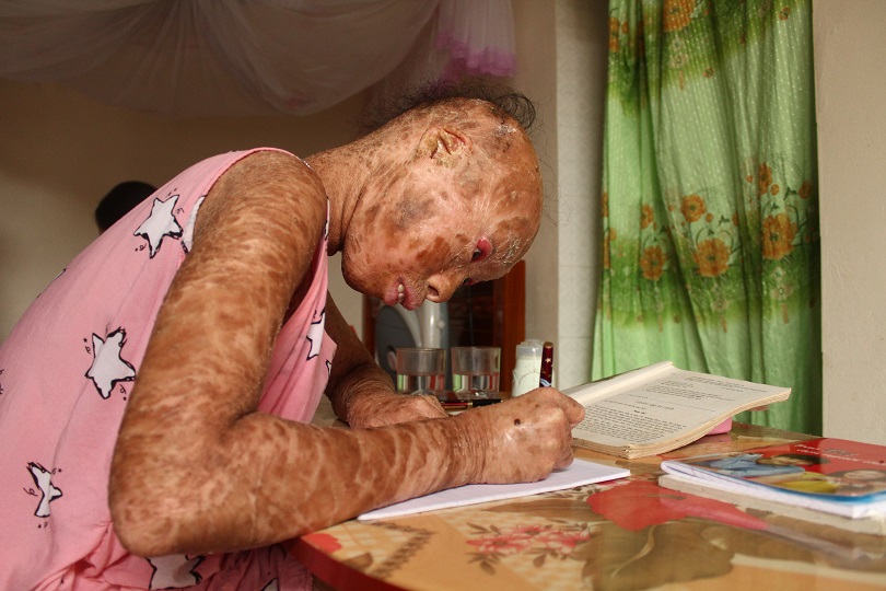 Xót thương 2 chị em mắc bệnh lạ, không dám đi học vì bạn gọi là 