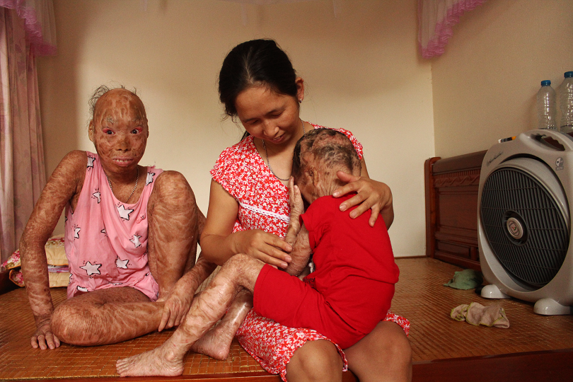 Xót thương 2 chị em mắc bệnh lạ, không dám đi học vì bạn gọi là