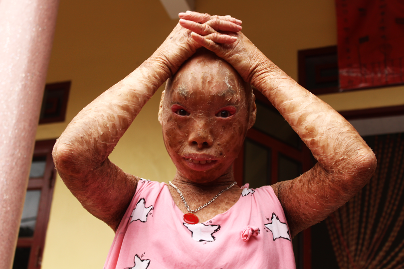 Xót thương 2 chị em mắc bệnh lạ, không dám đi học vì bạn gọi là 