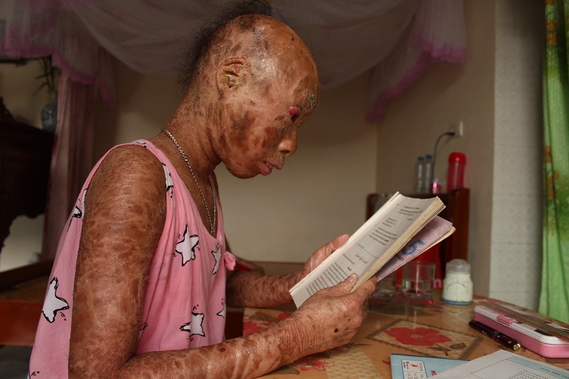 Xót thương 2 chị em mắc bệnh lạ, không dám đi học vì bạn gọi là