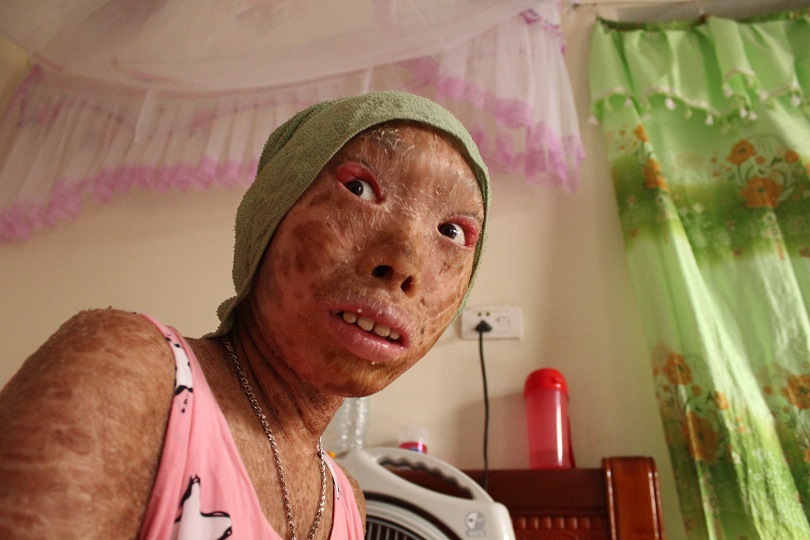 Xót thương 2 chị em mắc bệnh lạ, không dám đi học vì bạn gọi là 