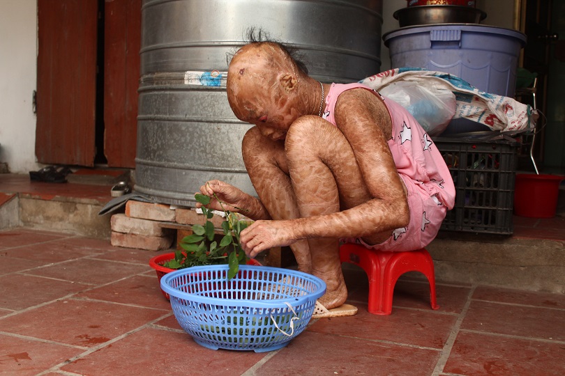 Xót thương 2 chị em mắc bệnh lạ, không dám đi học vì bạn gọi là