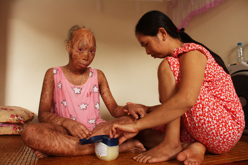 Xót thương 2 chị em mắc bệnh lạ, không dám đi học vì bạn gọi là