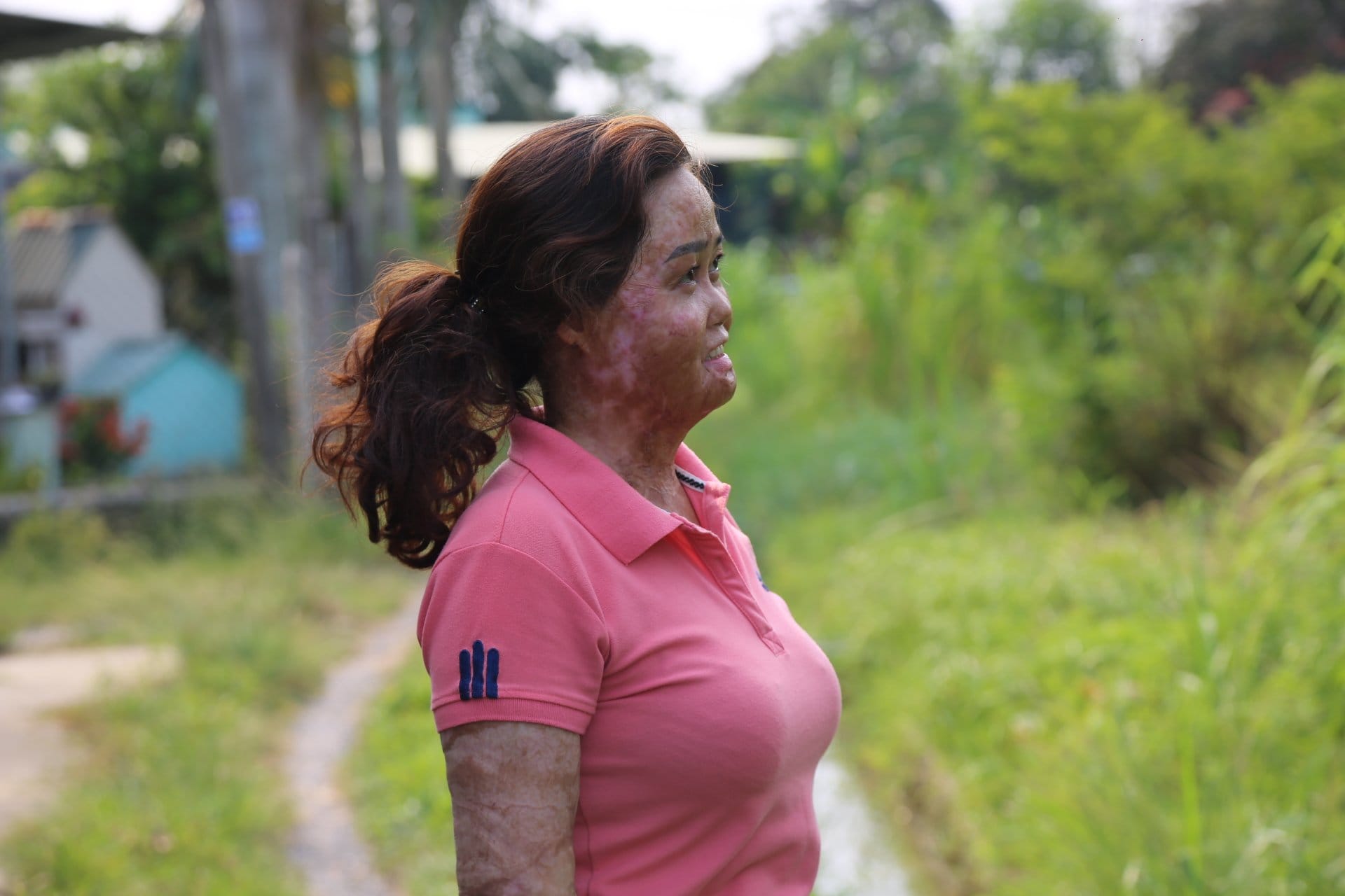 Chuyện tình của cặp đôi bị bỏng khắp cơ thể: Mình phải làm lại cuộc đời chứ, đúng không? - Ảnh 1.