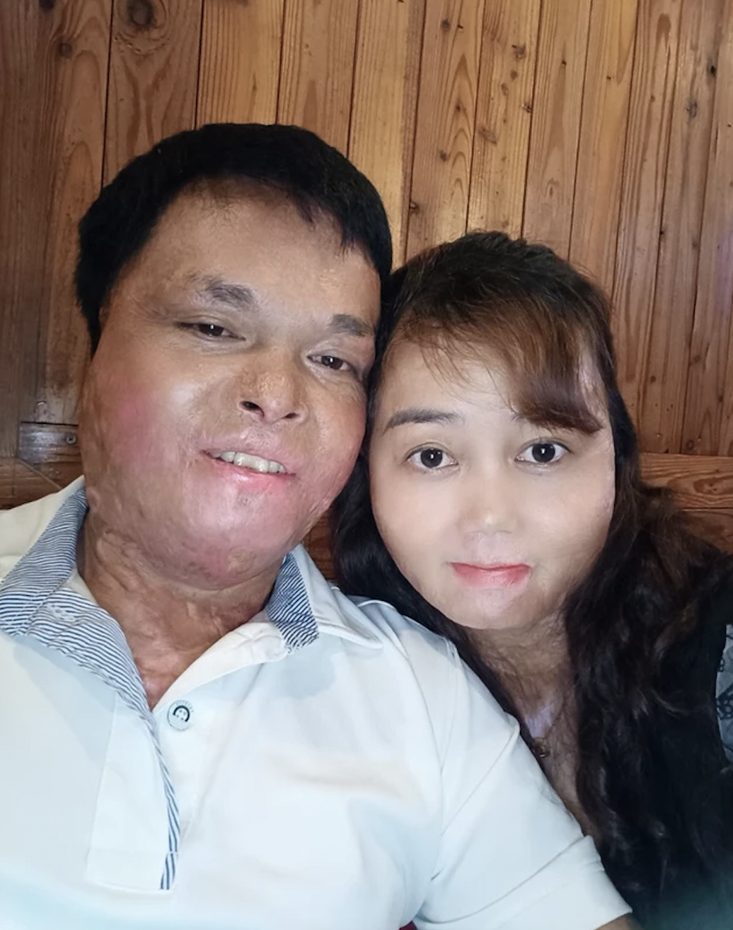Chuyện tình của cặp đôi bị bỏng khắp cơ thể: Mình phải làm lại cuộc đời chứ, đúng không? - Ảnh 3.