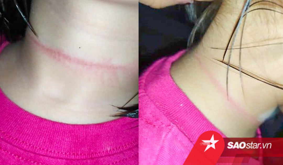 Bé gái 4 tuổi suýt mất mạng khi cố thực hiện theo thử thách treo cổ trên TikTok