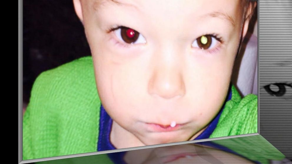 Retinoblastoma