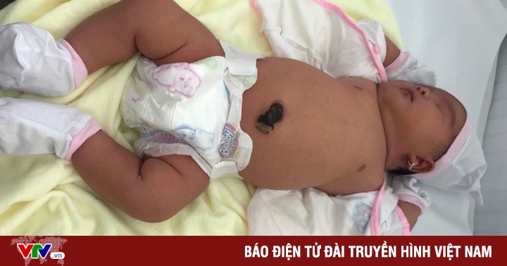 Nghe VietNamNet: Hiếm gặp: Bé gái chào đời với cân nặng 5,2 kg