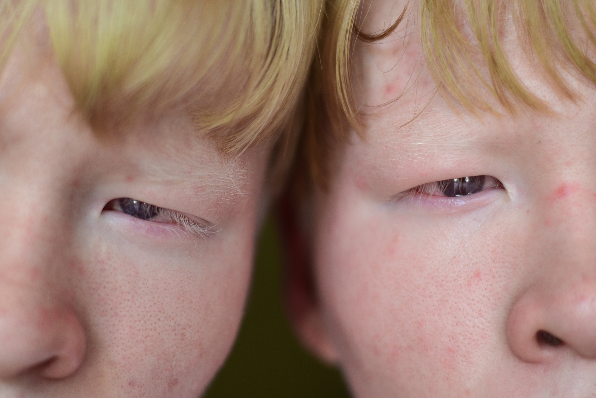 cap doi song sinh bach tang anh 5