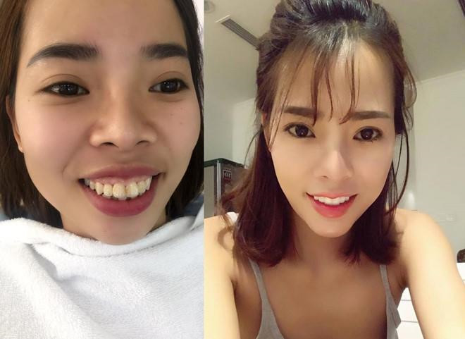 Nu sinh Canh sat va cac co gai 'lot xac' sau khi phau thuat tham my hinh anh 7