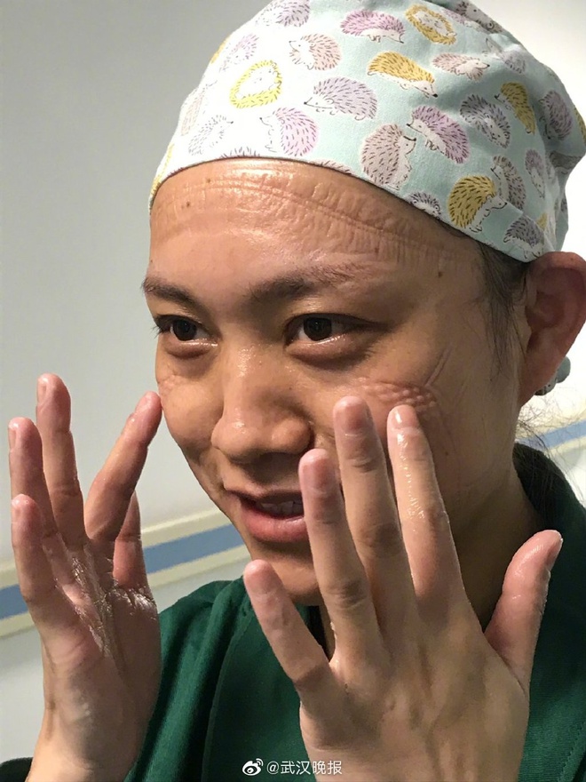 Bac si Vu Han mat han khau trang, dau cao troc vi chong dich corona hinh anh 9 555.jpg