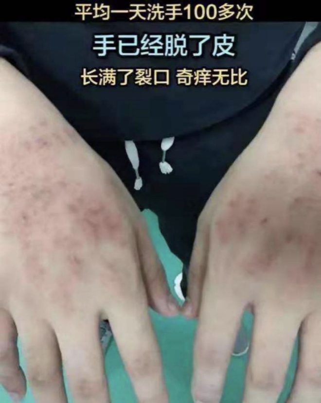 Bac si Vu Han mat han khau trang, dau cao troc vi chong dich corona hinh anh 7 922.jpg