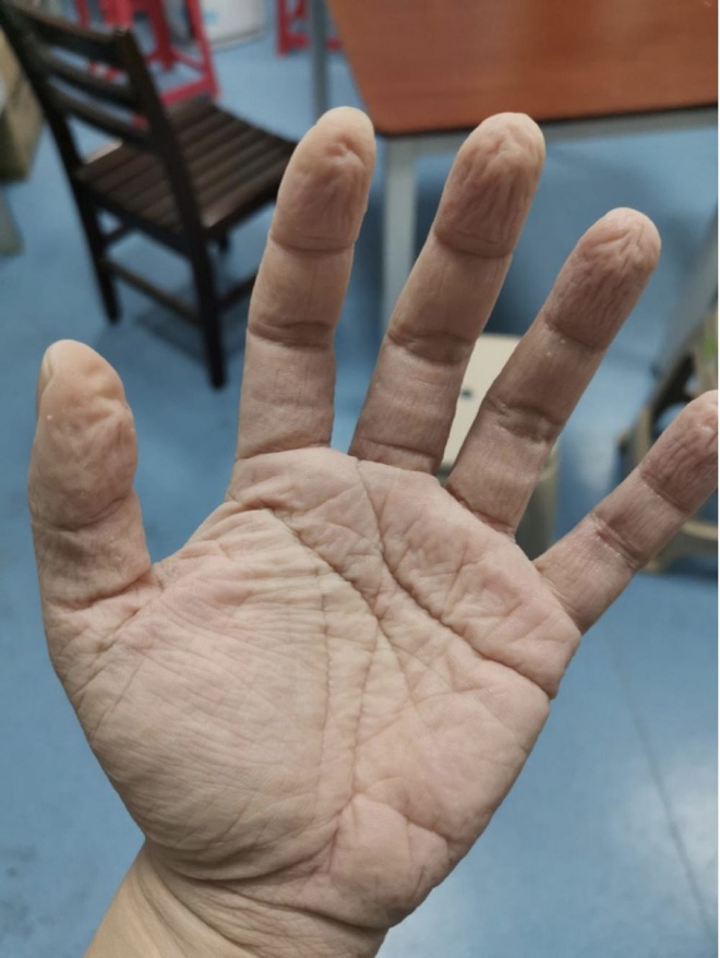 Bac si Vu Han mat han khau trang, dau cao troc vi chong dich corona hinh anh 6 923.jpg